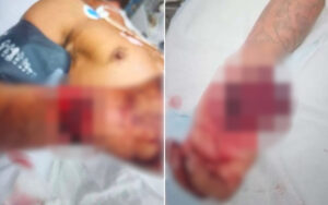 Twin-panel image showing a severely injured forearm in a hospital bed with bandages and medical tubing.